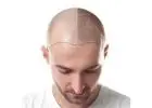 best hair replacement