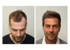 Hair Transplant in Islamabad