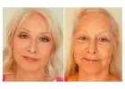 Get Rid of Wrinkles Quickly and Permanently!