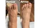 Bunion Specialist New Brunswick