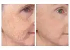 Fractionated CO2 Laser for Acne Scars & Pigmentation in Altamonte Springs, Orlando, Daytona Beac