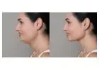 Double chin treatment in Islamabad