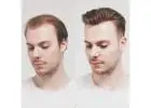 FUT Hair Transplant in Islamabad