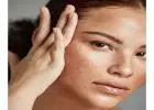 Melasma Treatment in Islamabad