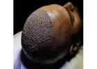 FUE Hair Transplant in Islamabad