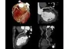 CT Coronary Angiography (CTCA)