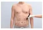 Abdominoplasty in Islamabad