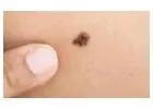 Mole Check